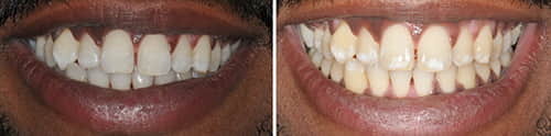 הלבנה של שיניים לפני ואחרי תוצאות