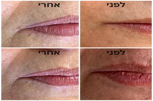 איפור קבוע שפתיים לפני ואחרי